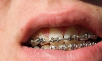 取金属牙冠疼吗，做了金属牙冠几年后疼