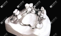 钛金属牙托有几种加工方法图解大全