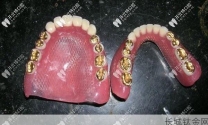 钛金属牙托和纯钛牙托的区别是什么呢
