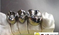 纯钛金属牙冠缺点有哪些呢